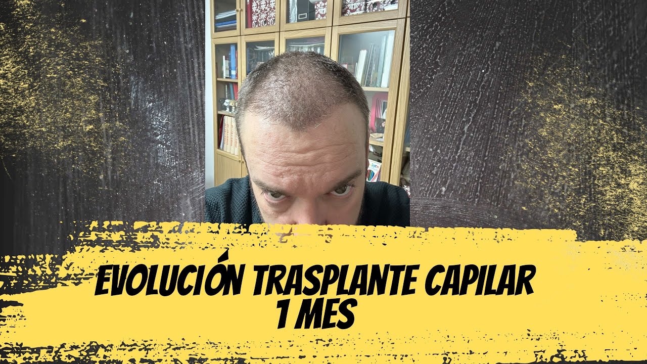 Evolución segundo Trasplante Capilar en Turquía - 1 mes