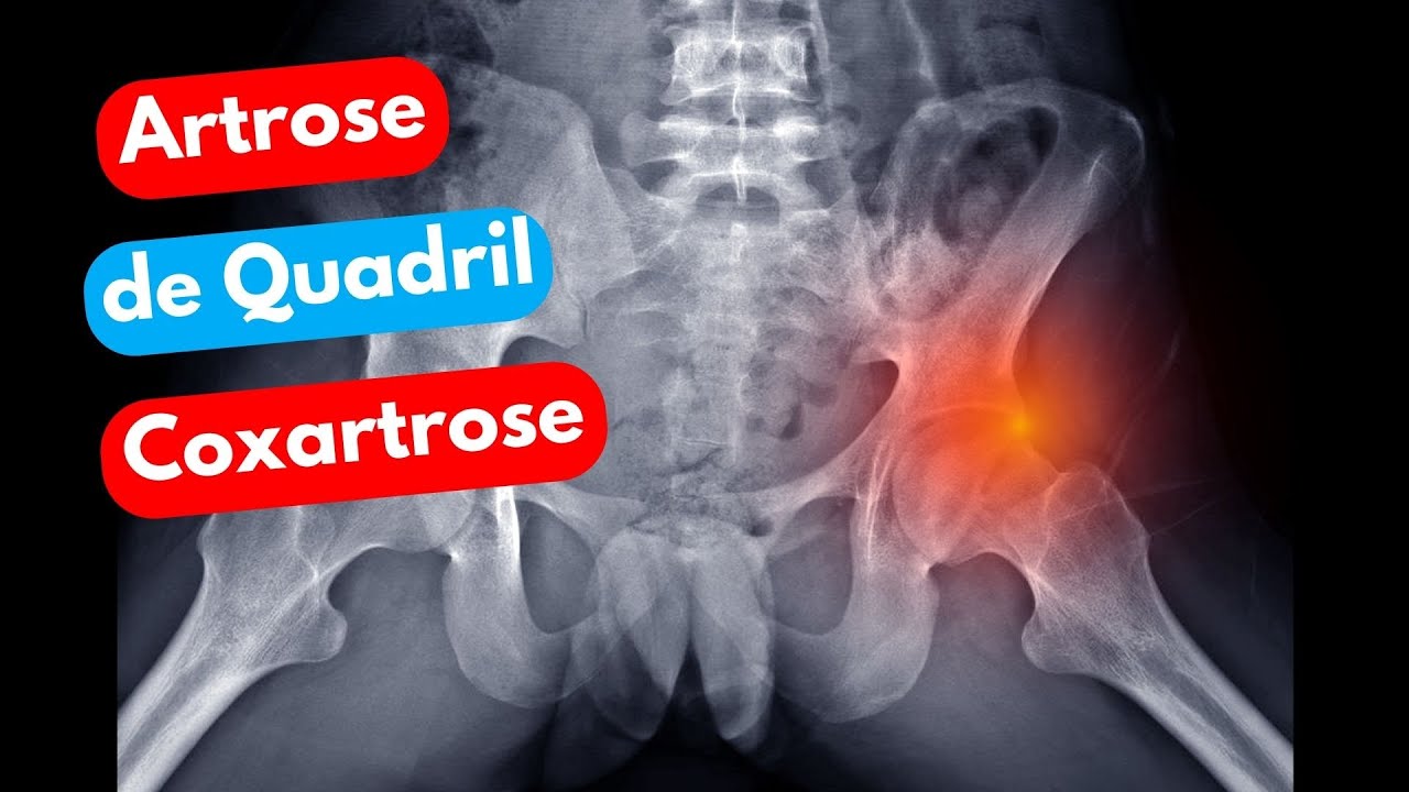 COXARTROSE - ARTROSE QUADRIL - Dr. Prof. Nelson Marques