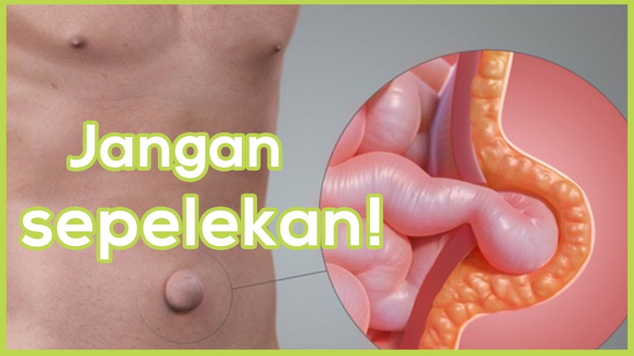 Kebiasaan Ini Bisa Memicu Hernia Pada Pria | Tanda Tanda Penyakit Hernia Pada Pria