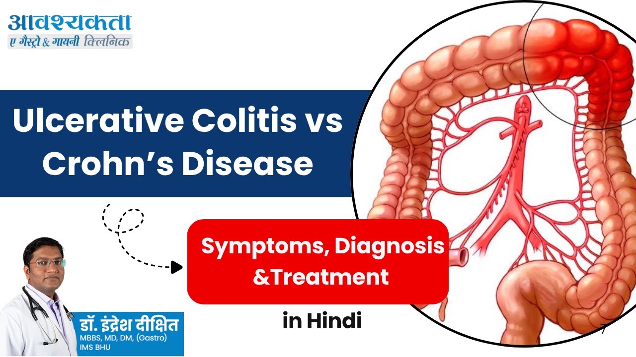 World IBD Day 2025 | Ulcerative Colitis vs Crohn&rsquo;s Disease | Symptoms, Diagnosis &Treatment in Hindi