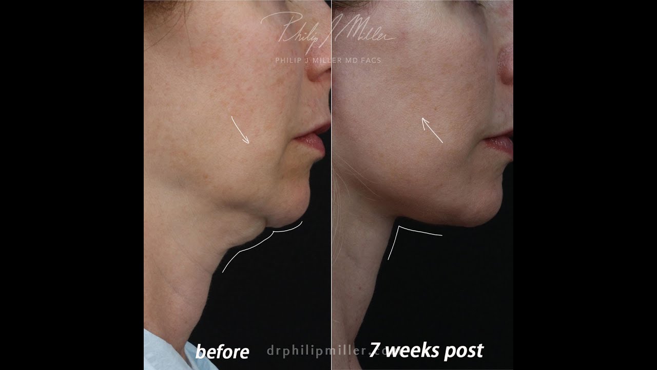 7 Weeks Post Op Deep Plane Facelift! What A Transformation!