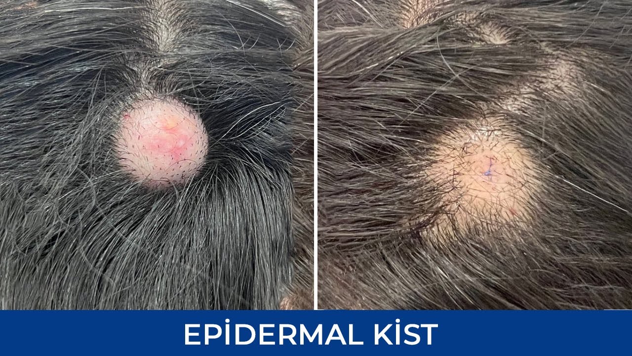 Epidermal Kist - Ateroma - Quba R&uuml;stəmova (Dermatoveneroloq - kosmetoloq )