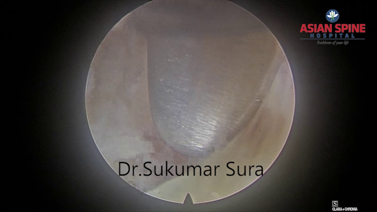 FULL ENDOSCOPIC SPINE SURGERY-TRANSFORAMINAL FORAMINOPLASTY and OSTEOPHYTE REMOVAL