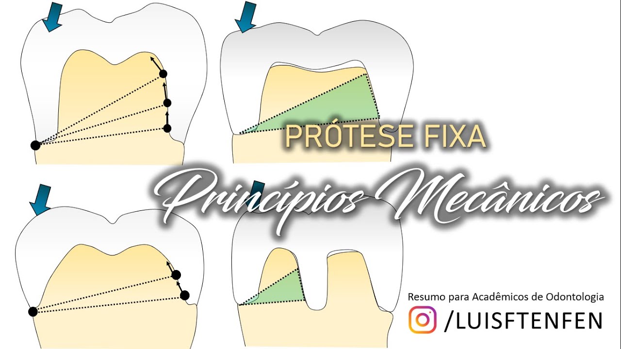 Prótese Fixa #2:  Princípios Mecânicos