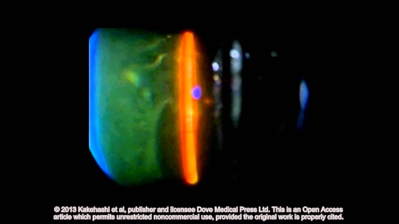 Classification of posterior vitreous detachment ID 54021 Supplementary video 6