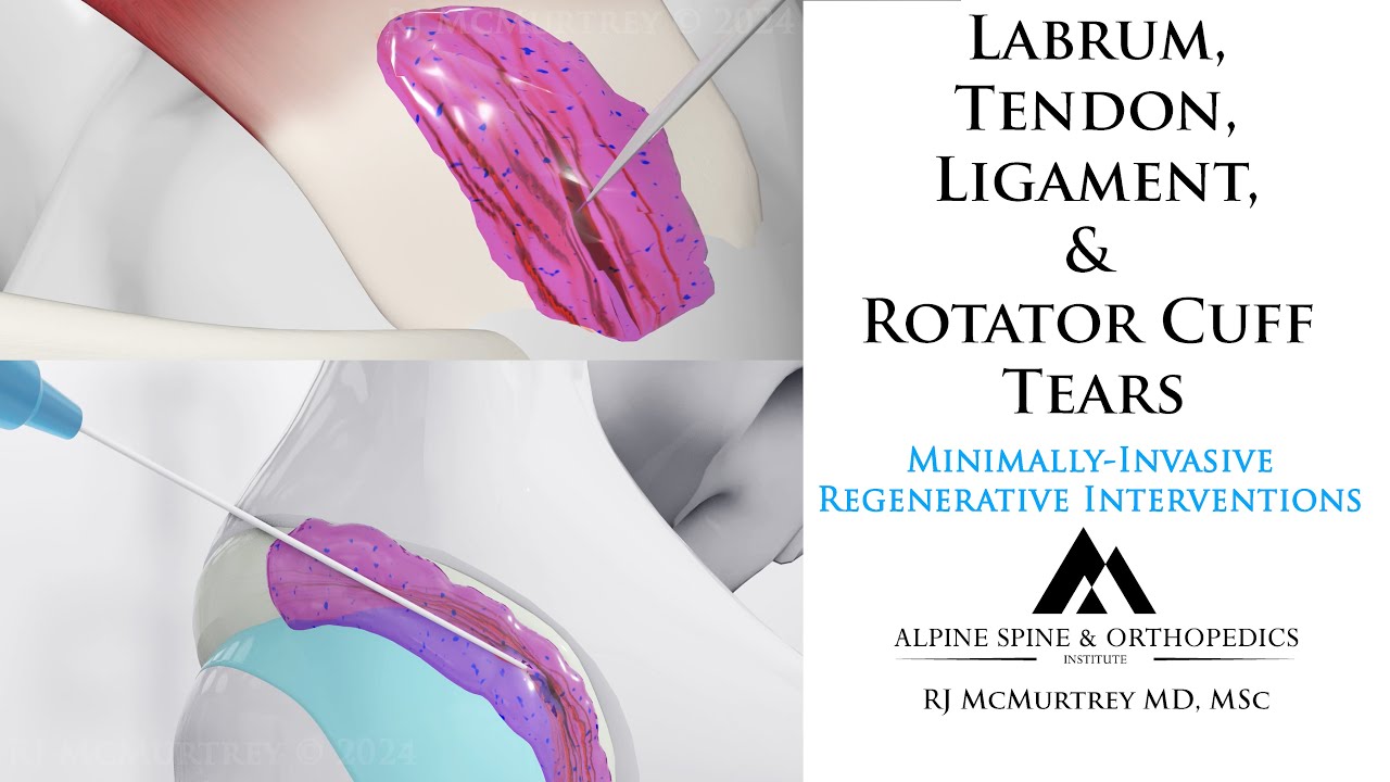 Tears of Rotator Cuff Tendon & Labrum: New Minimally-Invasive Regenerative Treatment Options
