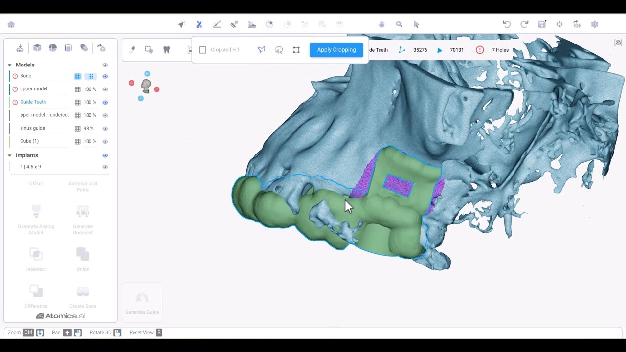 [Go Guided With Atomica] Advanced Sinus Lifting (Case Study)