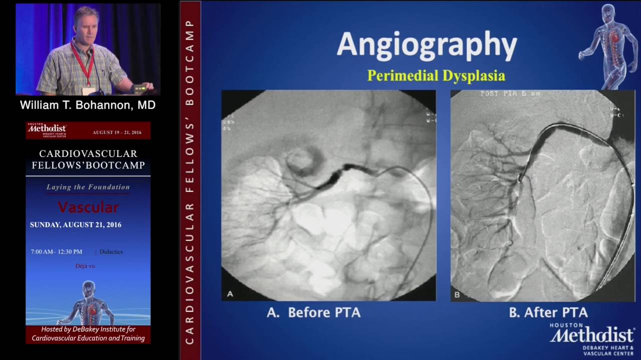 Management of FMD (William T. Bohannon, MD) Saturday, August 20, 2016