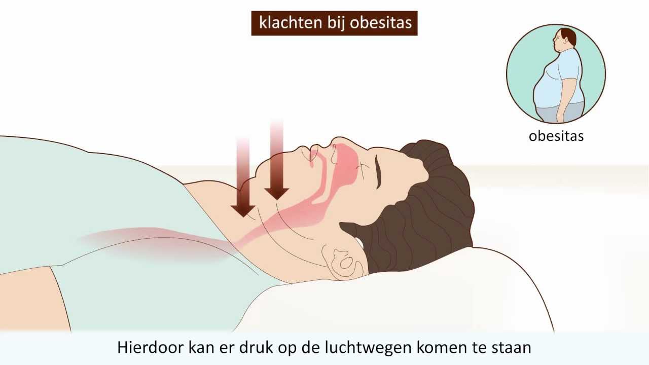 Obstructief Slaap Apneu Syndroom (OSAS) - Wat is OSAS en  hoe kun je het voorkomen?