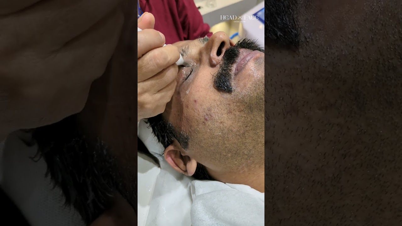 microdermabrasion Treatment 