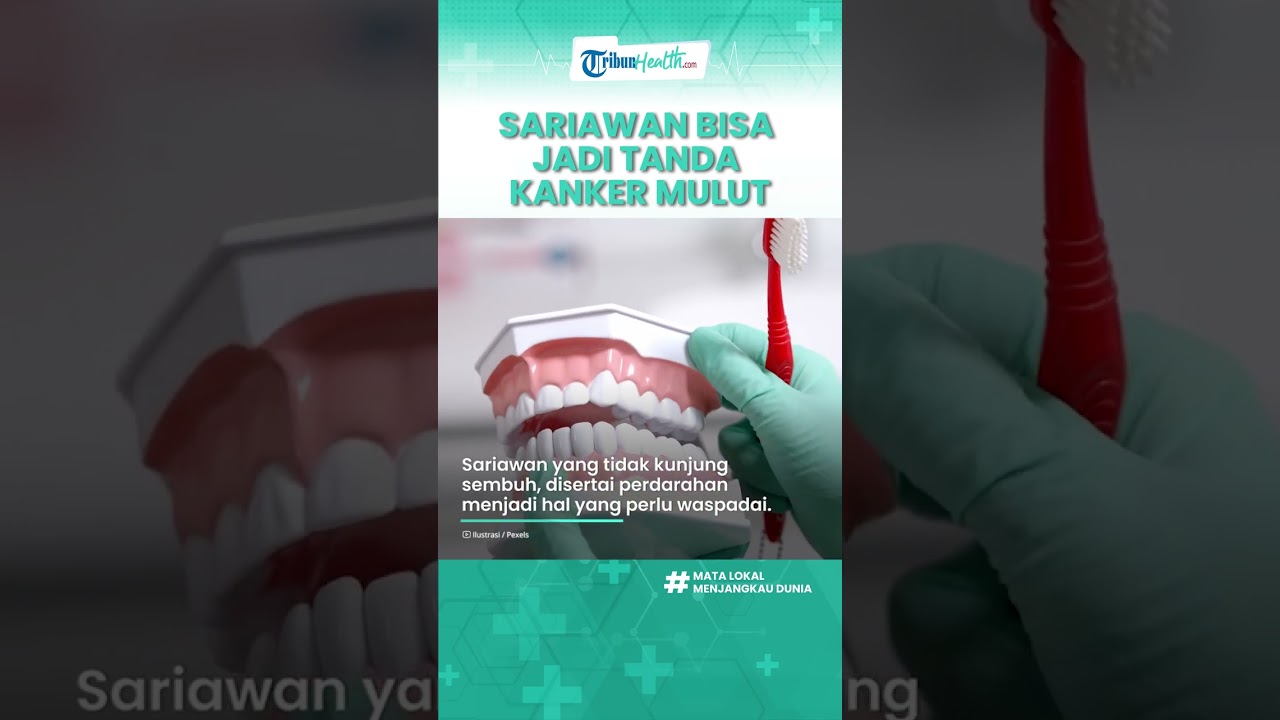 Sariawan Tak Kunjung Sembuh Tanda Kanker Mulut, Kenali Gejala dan Penyebabnya