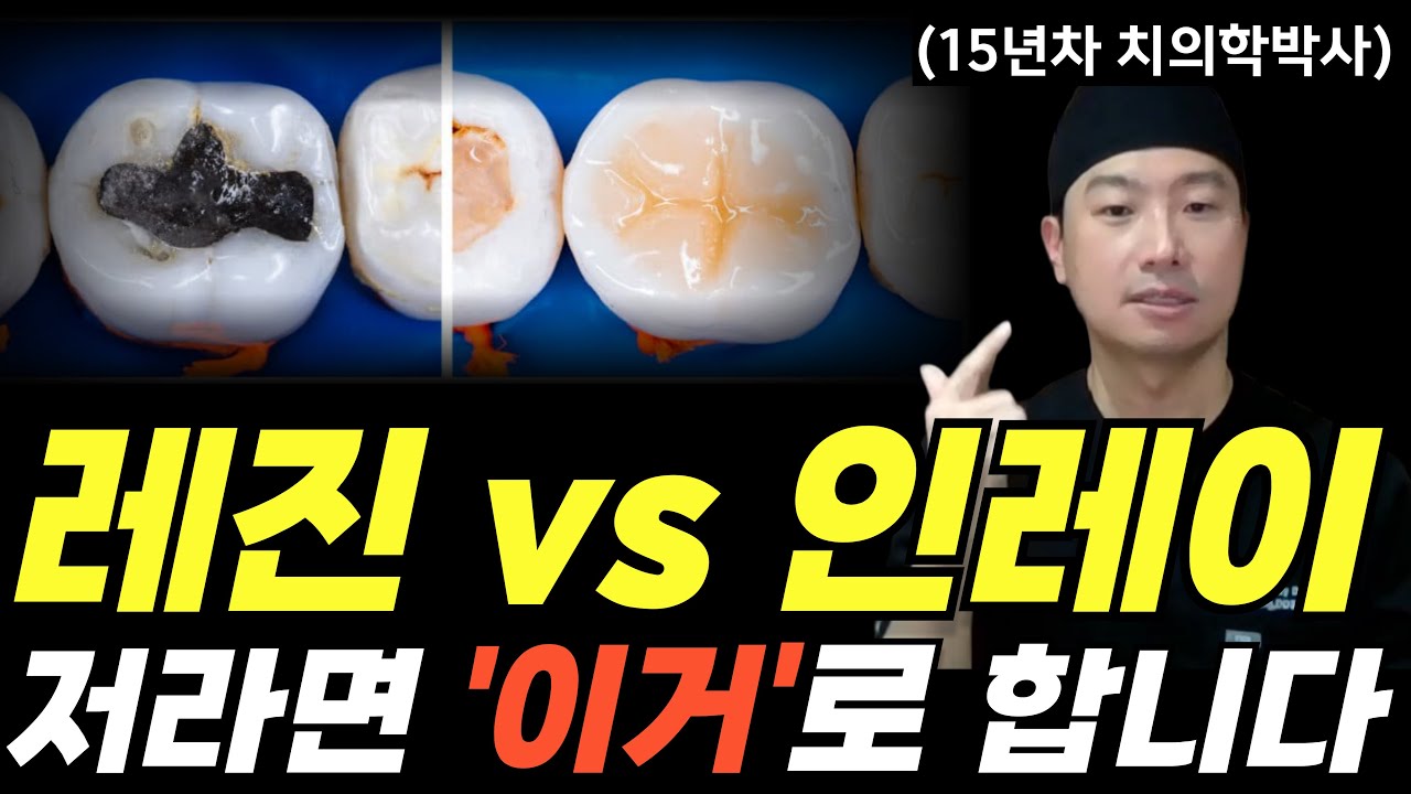 요즘 충치치료는 이거로 합니다 l  치과가기 전 꼭 보세요,  모르고 가면 100% 손해!