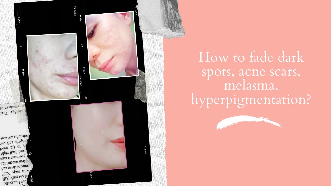 Fade Hyperpigmentation, Acne Scars, Dark Spots, Melasma, Age Spots
