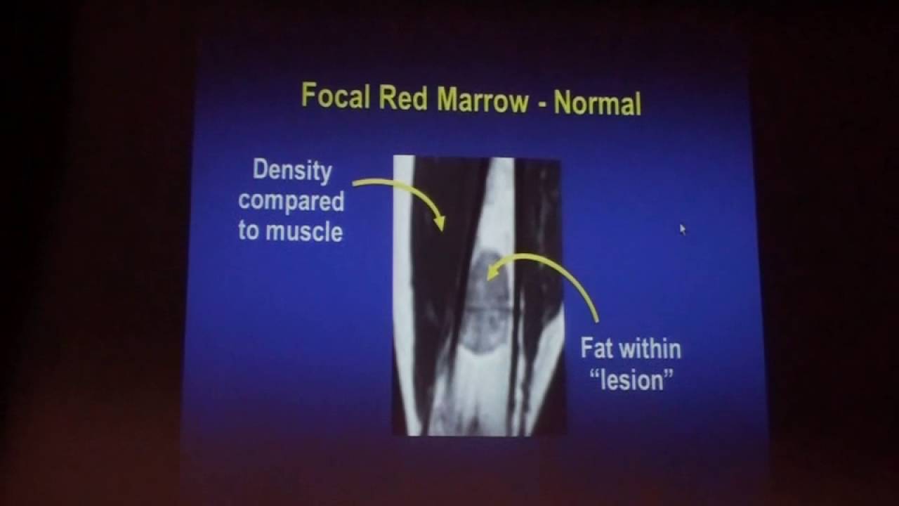 Bone Marrow Abnormalities on MRI An Approach to Analysis in 2012 - Mary Hochman