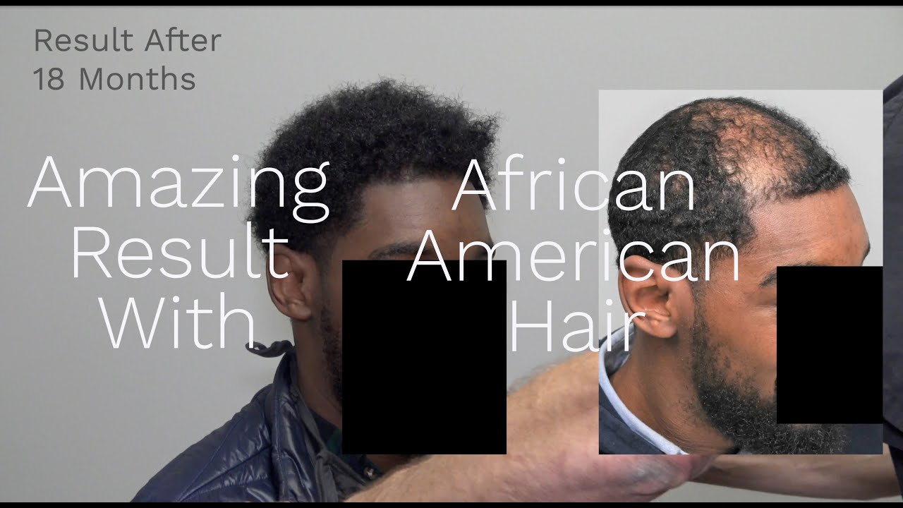African American Patient With Amazing Hair Transplant Results
