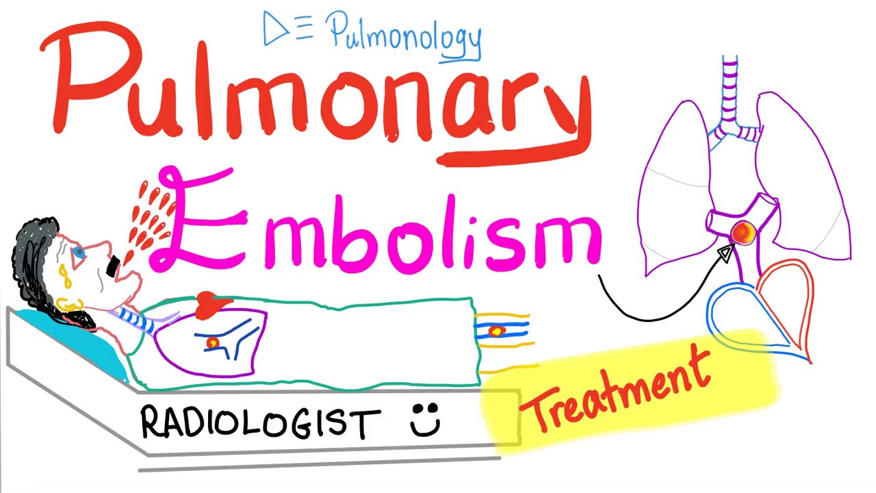 Pulmonary Embolism (PE) - Treatment - Thromboembolism - Pulmonology Playlist