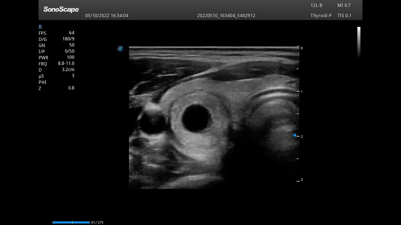Thyroid Scanning P25 12-lb linear probe