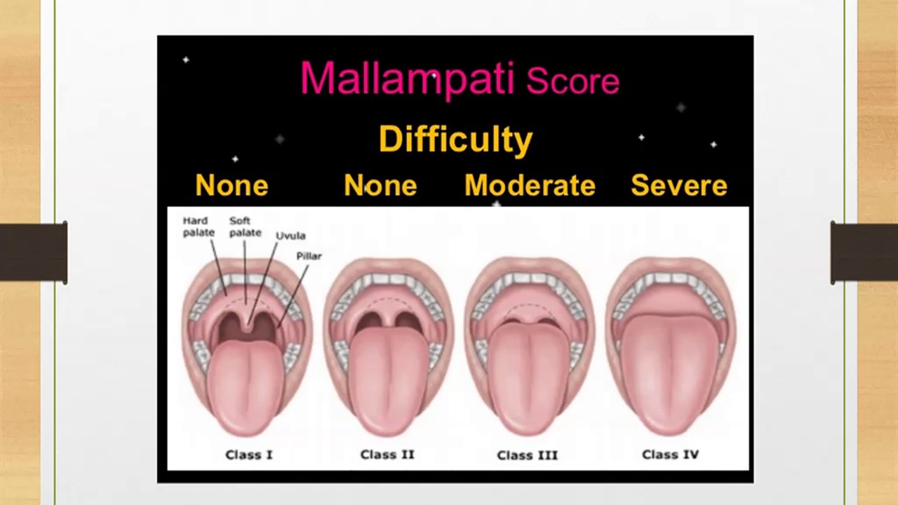 Rapid Sequence Intubation