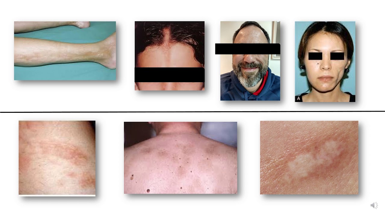 Esclerodermia Sistémica