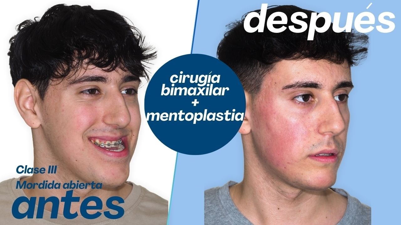 Cirugía bimaxilar Caso #181: Alex -Clase III severa, Hipoplasia maxilar, Mordida abierta