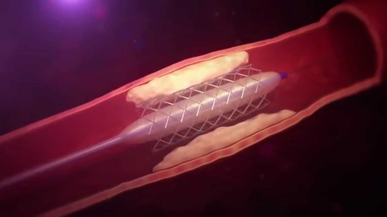 Angiographie