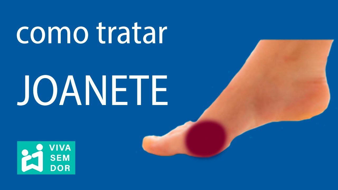 Como tratar joanete.