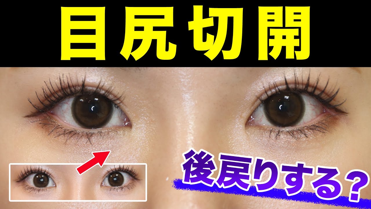 【目尻切開】意味ない？後戻りする？症例とともに徹底解説【目尻靭帯移動】