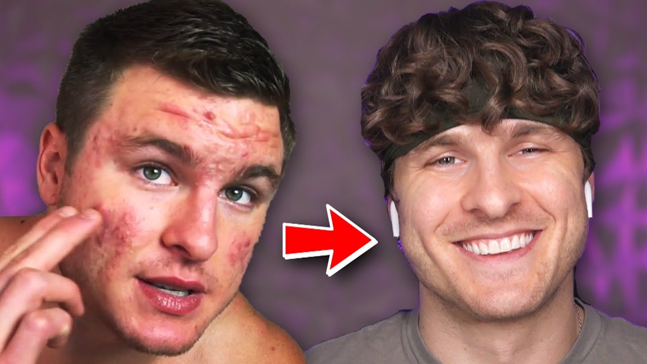 GET RID OF REDNESS FROM ACNE & SCARRING (FROM EXPERIENCE)