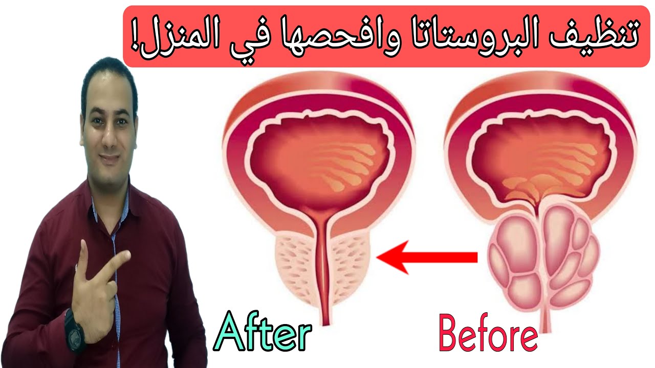 علاج وتنظيف البروستاتا | وداعاً ضعف الانتصاب وسرعه القذف | كيفية فحص البروستاتا في المنزل😍