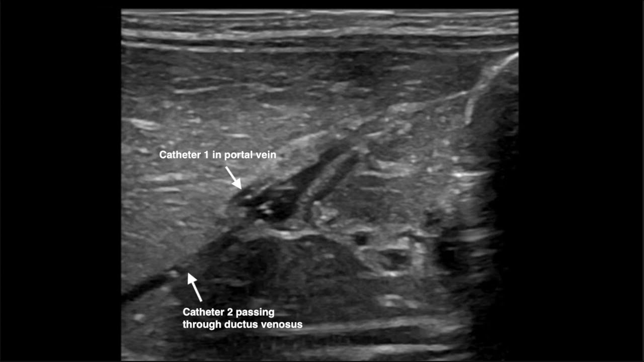 Ultrasound-guided UVC 4_Dual-Catheter Technique for Umbilical Venous Cannulation (Kozyak et al)