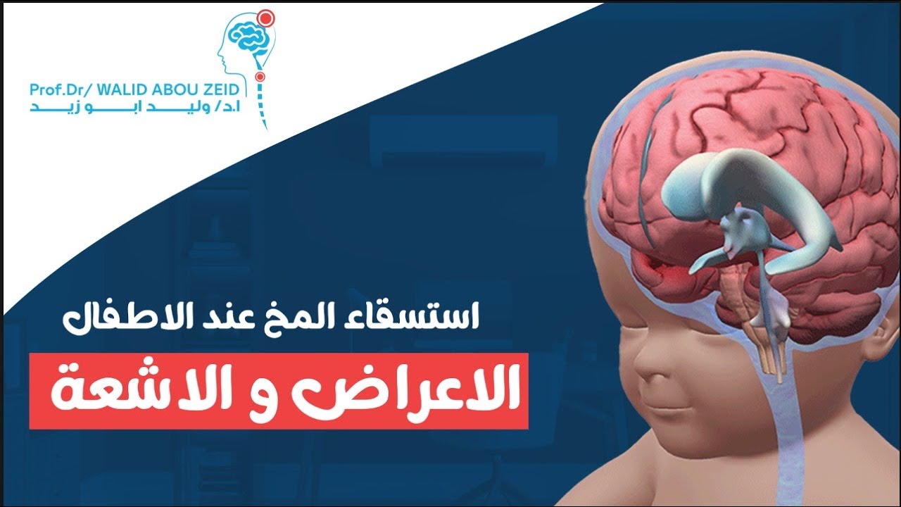 استسقاء المخ عند الاطفال | الاعراض والاشعة المطلوبة والعلاج