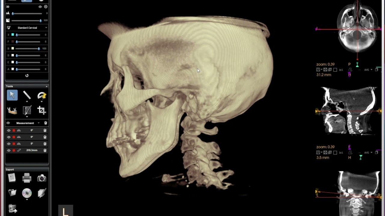 CBCT short intro to Blair Upper Cervical analysis.
