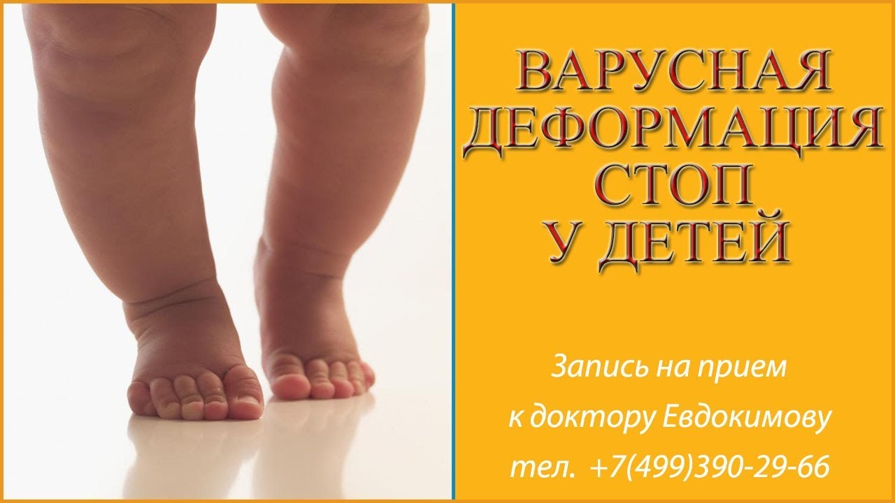 Варусная деформация стоп у детей. Варус причины, симптомы, лечение остеопатией.