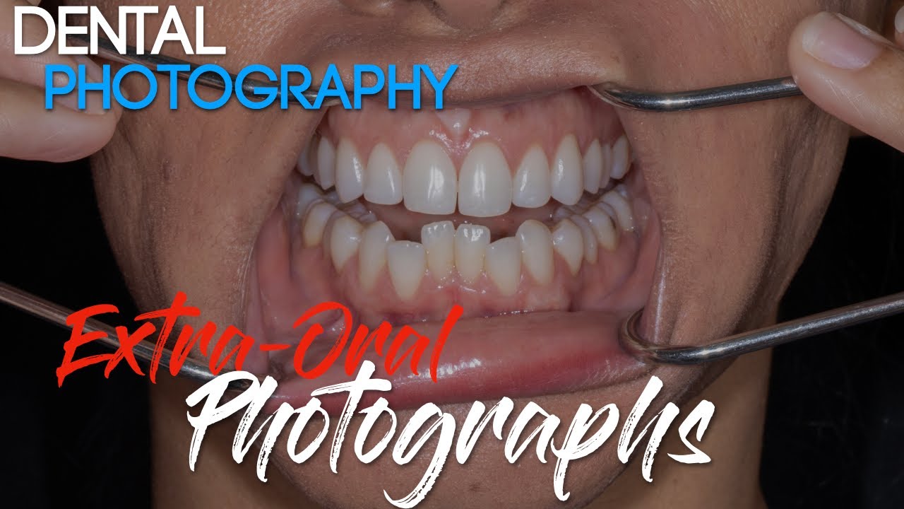 Dental Photography Basics - Dental Photography Techniques - Extra-oral Photographs