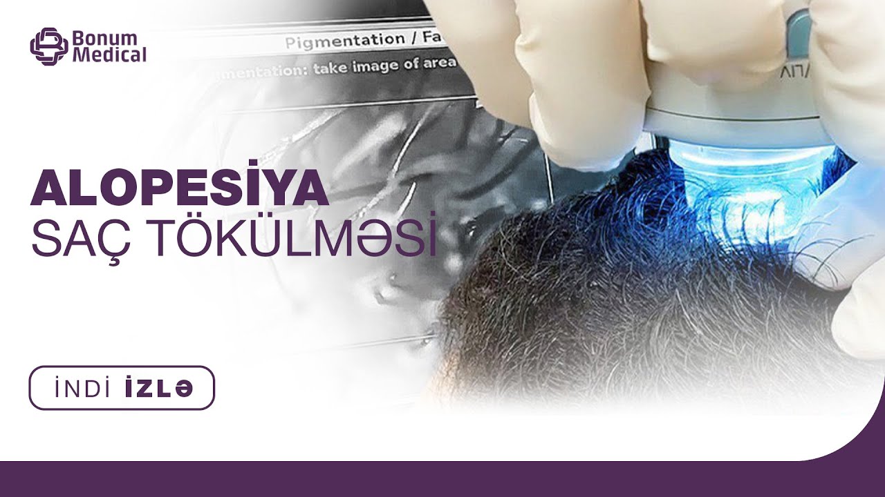 Alopesiya - SAÇ TÖKÜLMƏSİ | Dermatoloq Kosmetoloq - Pərviz Dadaşov