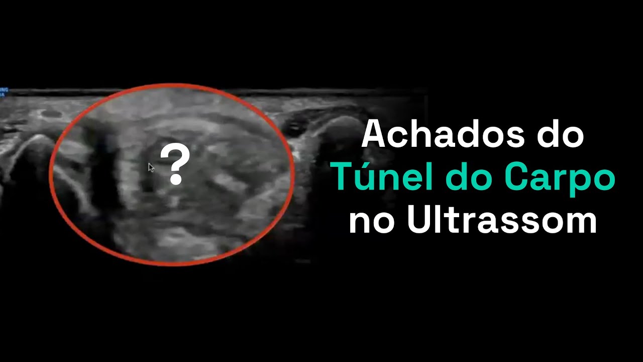 Achados do Túnel do Carpo no Ultrassom