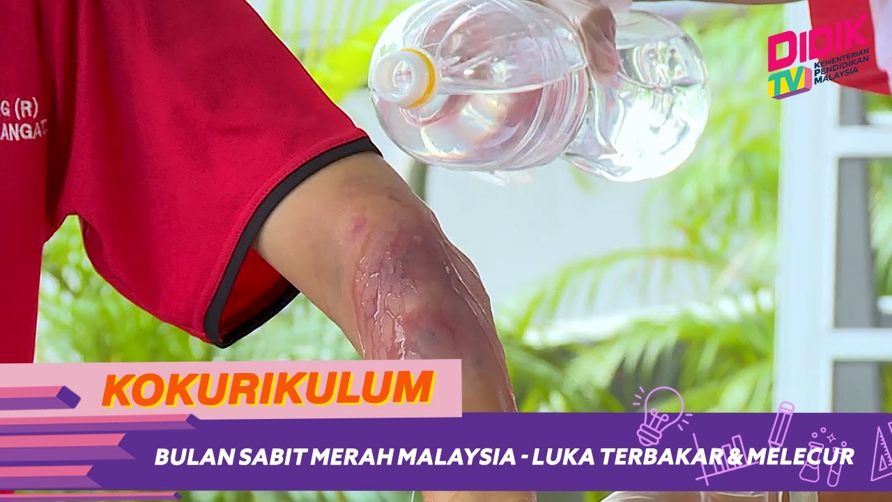 Kokurikulum (2021) | Bulan Sabit Merah Malaysia - Luka Terbakar & Melecur
