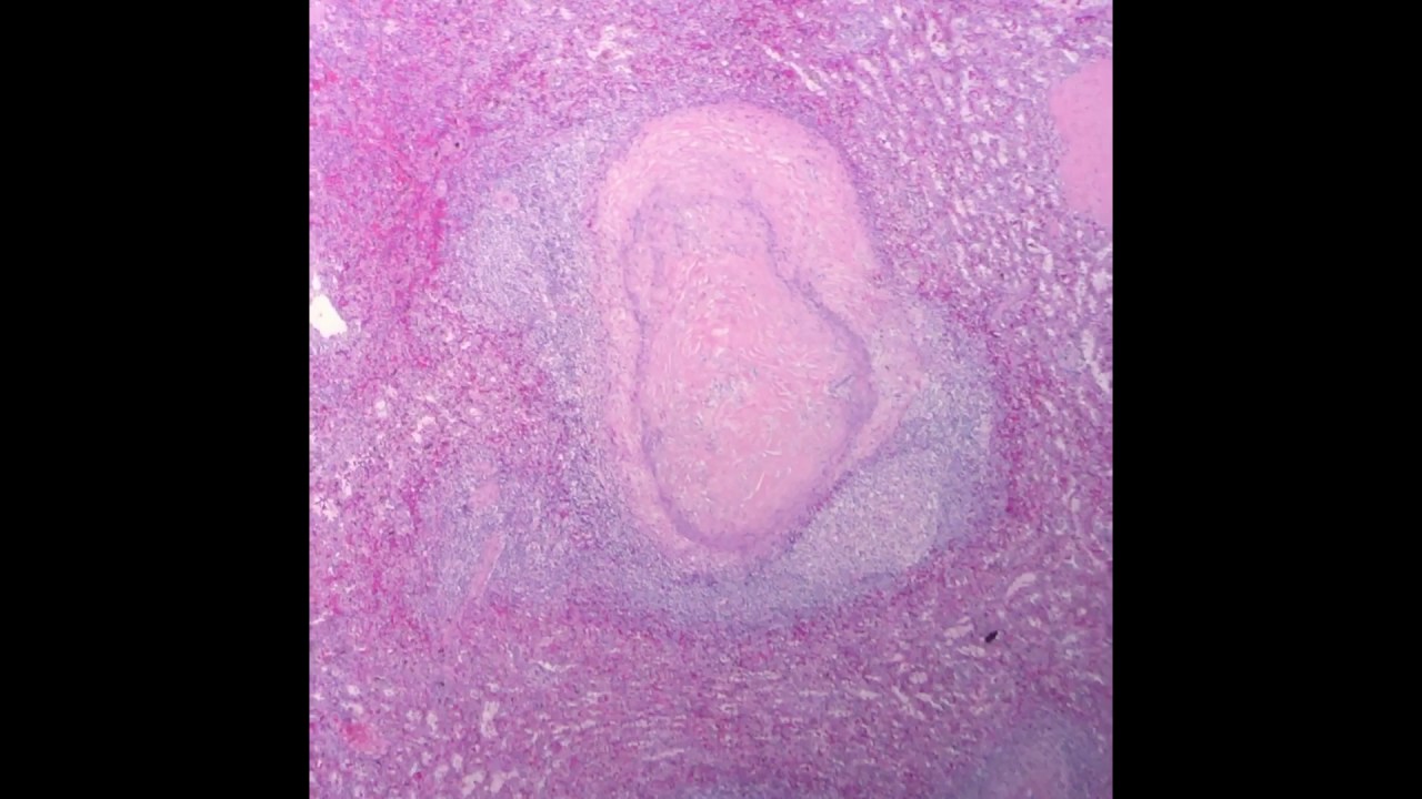 An Approach to Benign Spleen