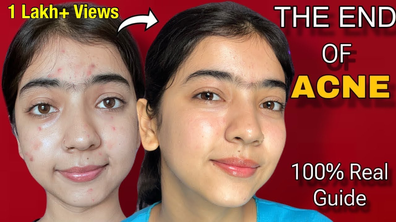 This is how you can Permanently Cure Acne|✅100% Real| Acne treatment| Acne pimple, Darkspot #acne