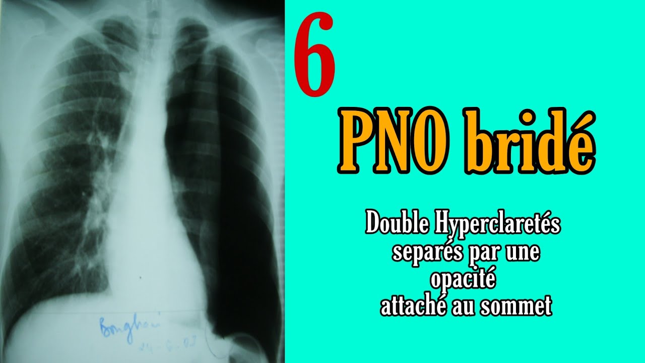 Telethorax 6 : PNO bridé ( Syndrome pleural : Hyperclareté en bande)