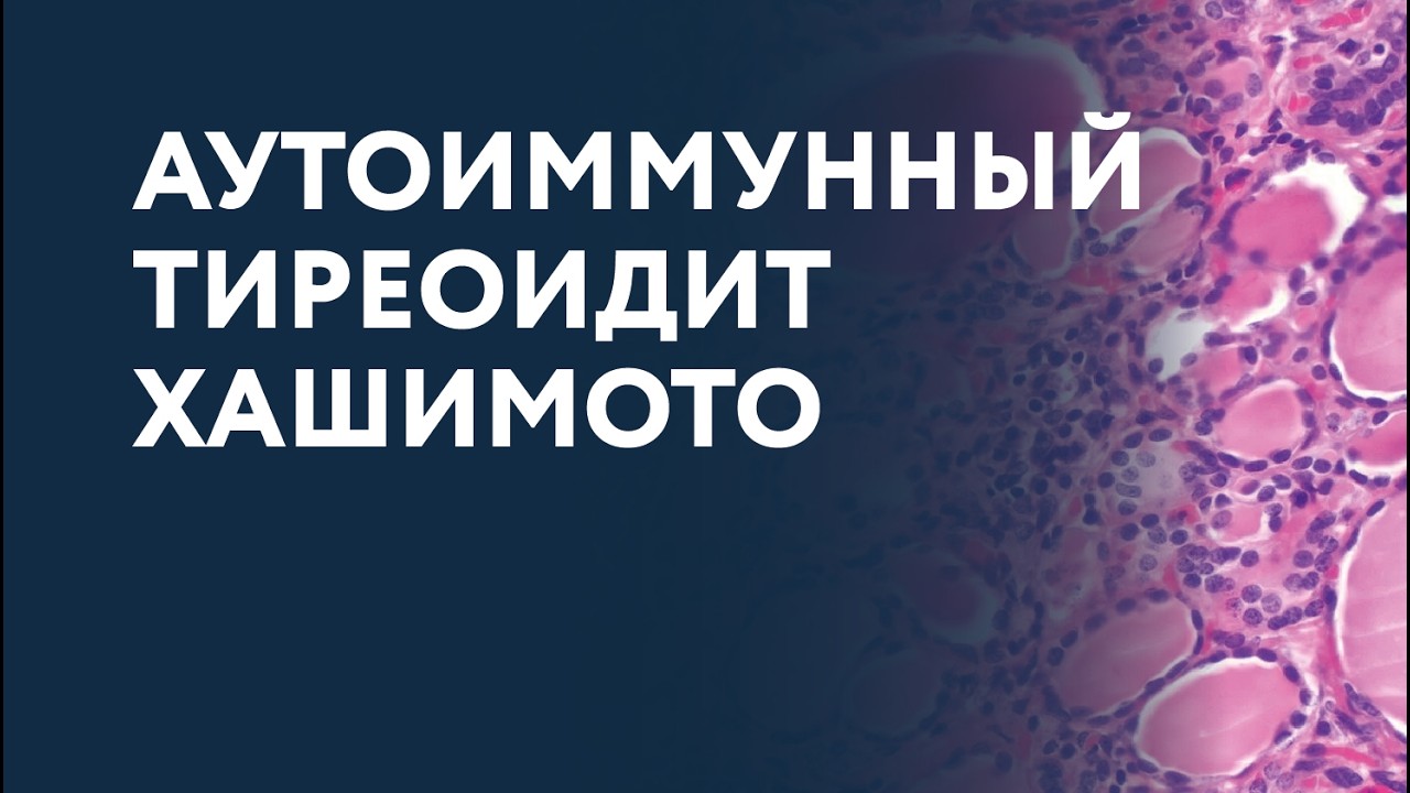 АУТОИММУННЫЙ ТИРЕОИДИТ ХАШИМОТО