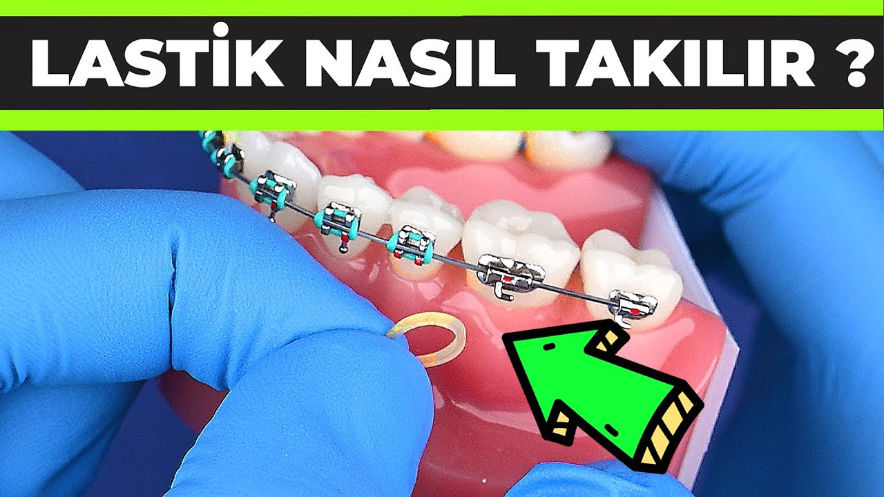 DİŞ TELİ LASTİĞİ | Nasıl Takılır & Ne İşe Yarar ?- Dr. Dt. Deniz Ertüz