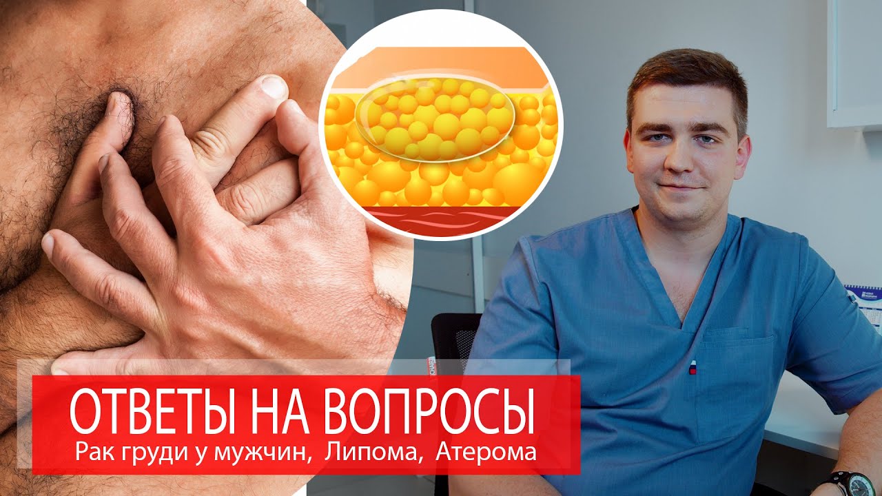 Рак груди у мужчин, Липома, Атерома, Жировик | ОТВЕТЫ НА ВОПРОСЫ
