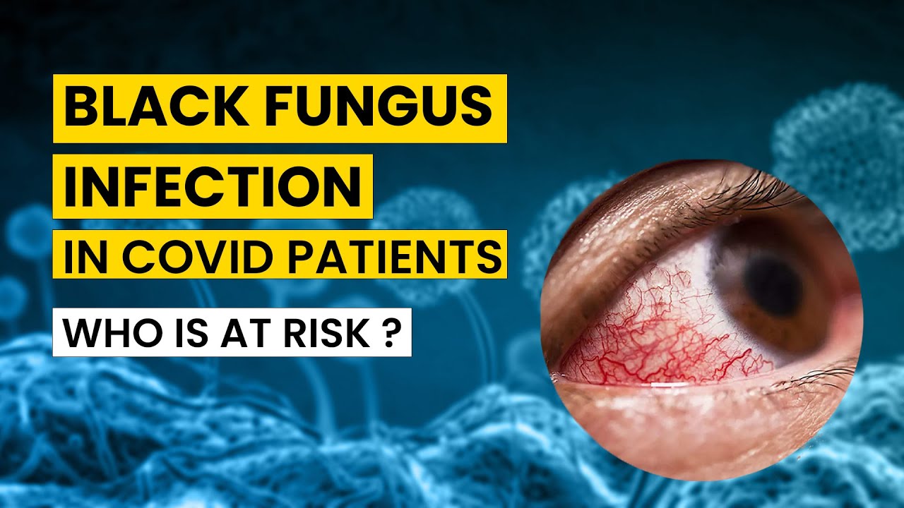 'Black Fungus Infection' in India: In-Depth Explanation By Top Medical Expert