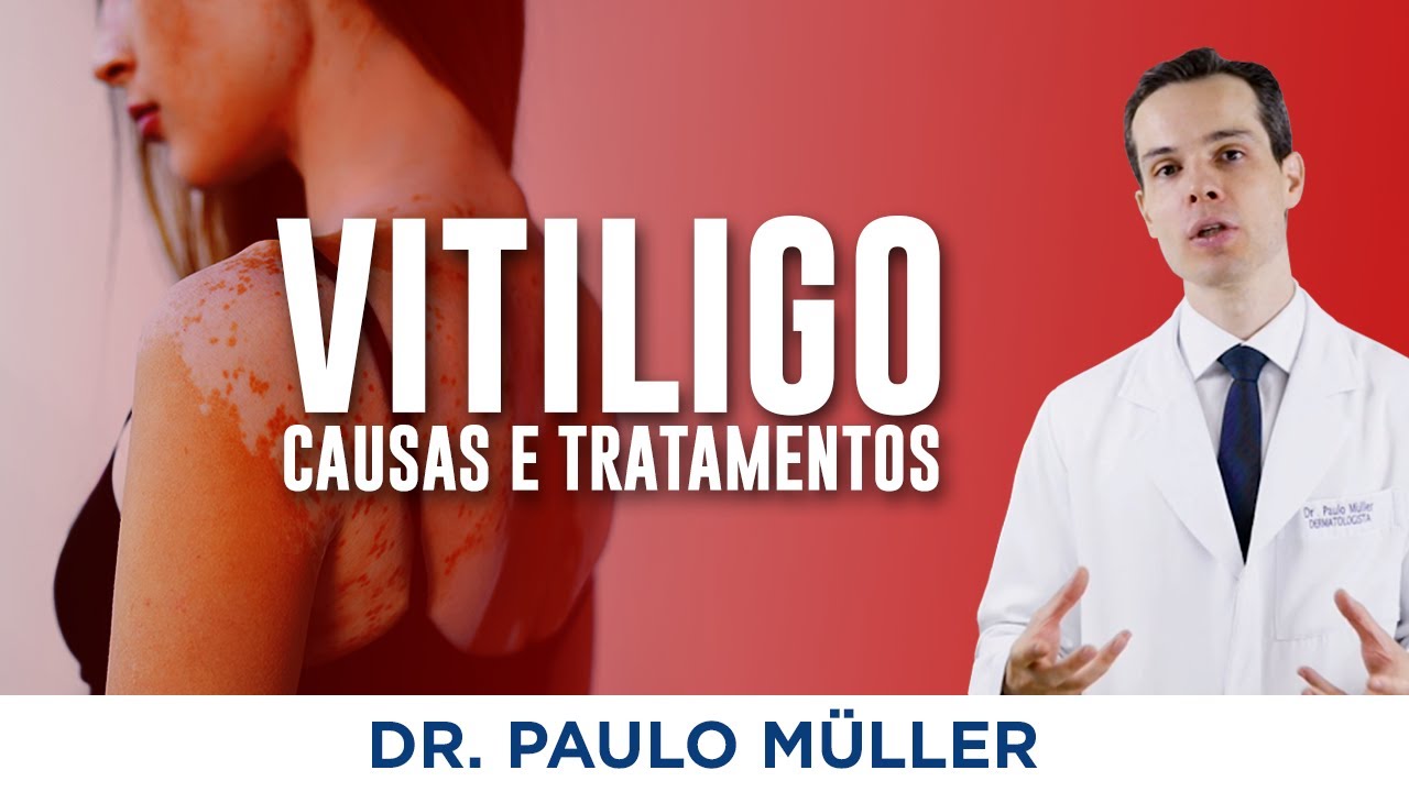 Vitiligo - O que você precisa saber sobre essa doença! - Dr. Paulo Müller Dermatologista
