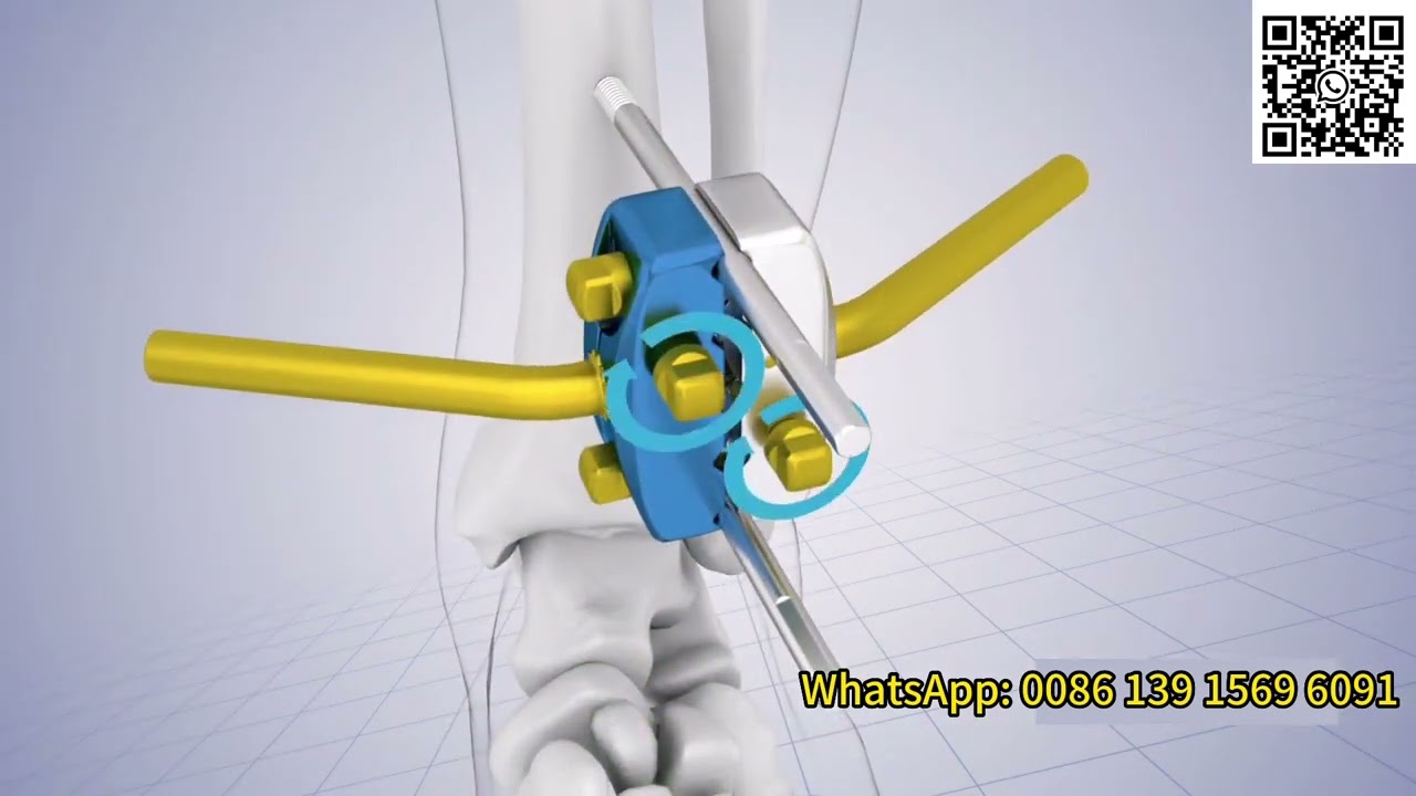 Stryker Combined External Fixator