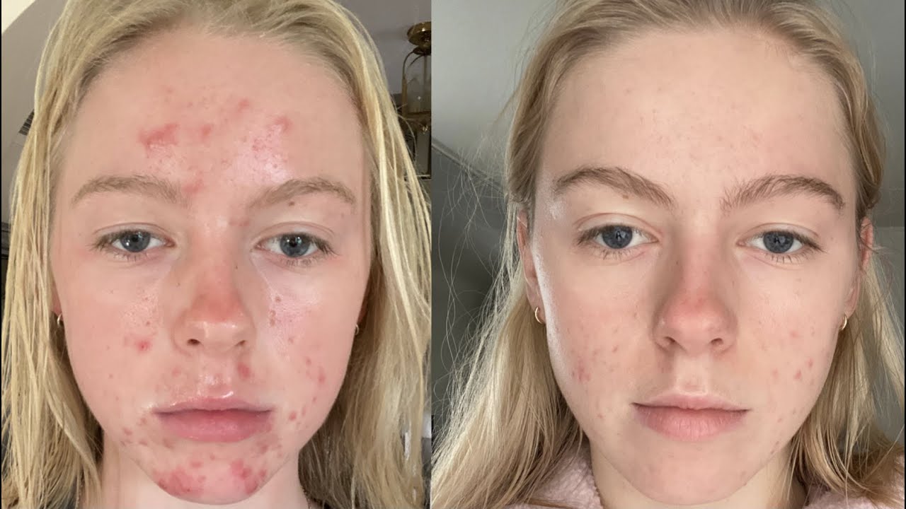 my accutane experience | what didn't work + pictures