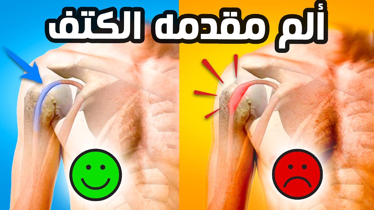 المسبب الرئيس لألم عضلات الاكتاف والذراع || اختبار + علاج التهاب وتر الباي