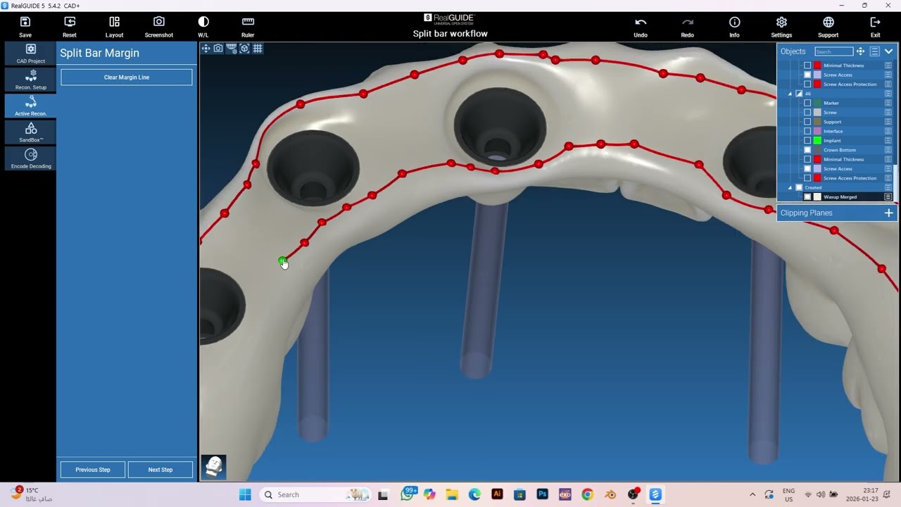 Split Bar Design Workflow in RealGUIDE CAD Based on Wax-Up