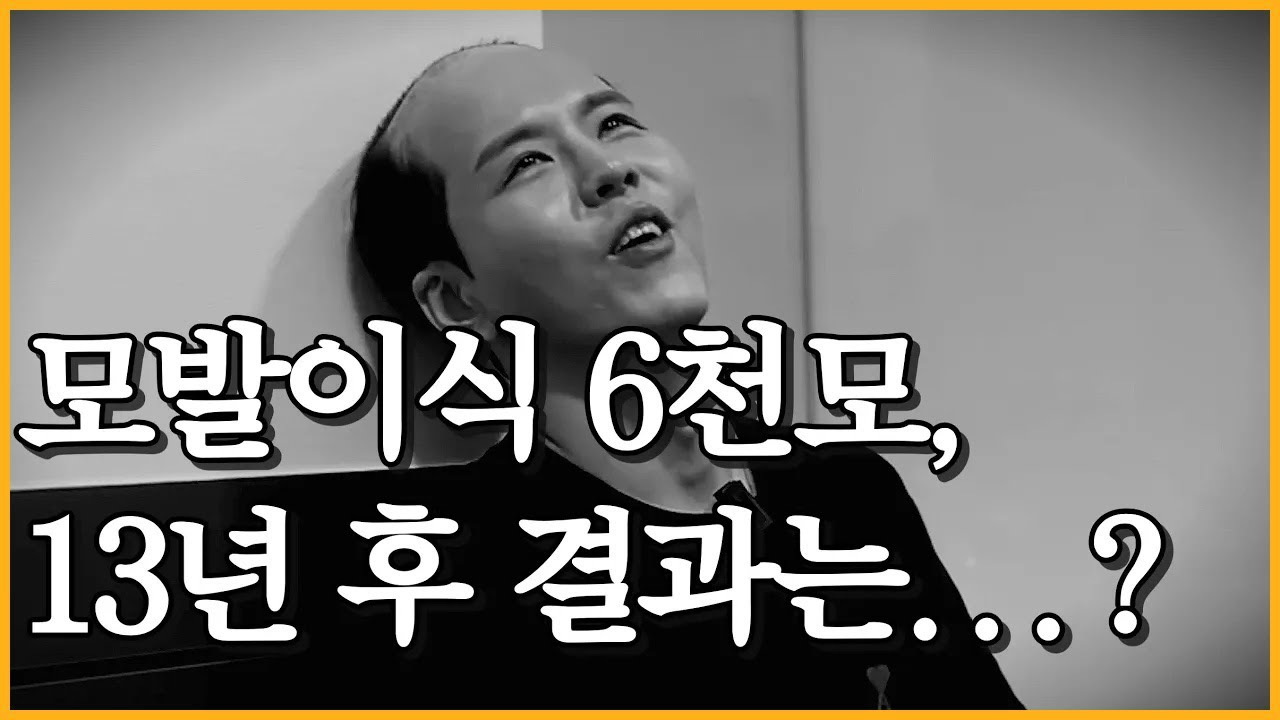 [모발이식] 모발이식한 6000모의 머리카락은 제대로 남아있을까요? 두 번의 절개 모발이식, 13년 후 결과 공개!